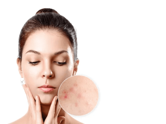 Acne (Pimples) Treatment.