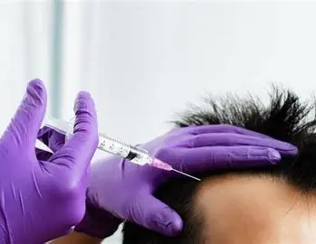 Hair-Transplant