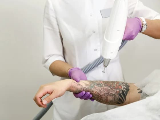 Tattoo Removal